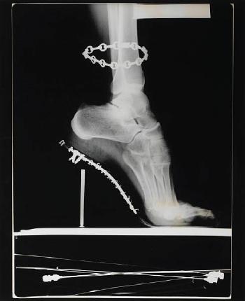 X-Ray of High Heeled Shoe and Cartier Bracelet, Paris-1994 X-Ray of High Heeled Shoe and Cartier Bracelet, Paris-1994
